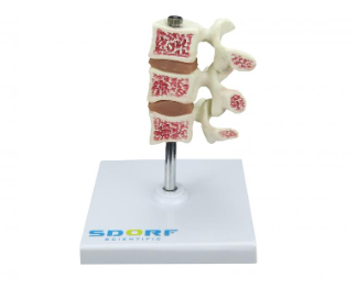 MODELO DE OSTEOPOROSE